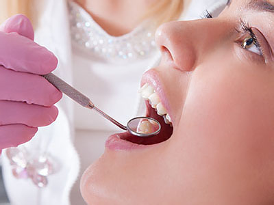 dental fillings Kissimmee